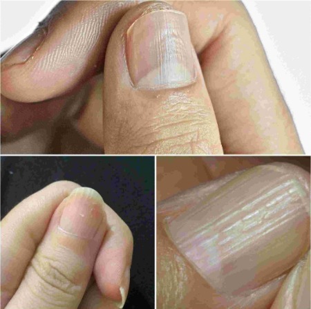 Understanding the Real Causes of Vertical Ridges on Your Nails