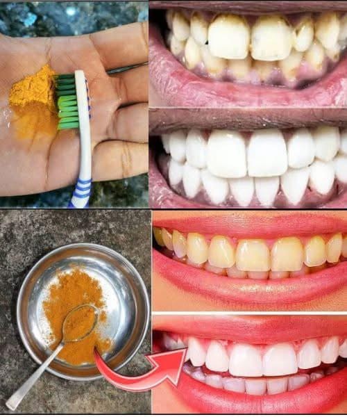 Natural Teeth Whitening – Say Goodbye to Yellowing and Tartar