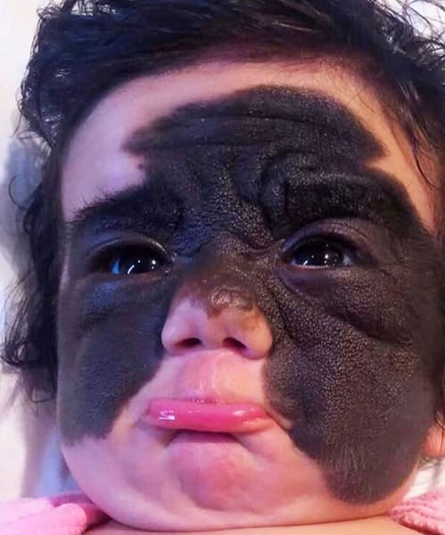 ‘Batman’ birthmark is finally removed from girl following ground-breaking procedure