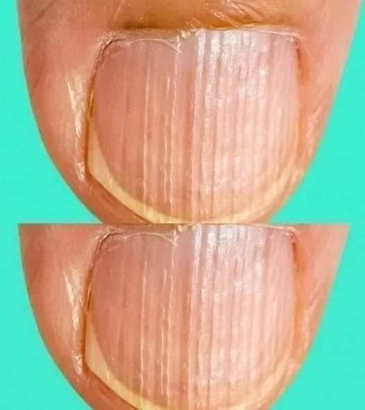 Having Striped Nails Could Mean That Your Body Is… Read More