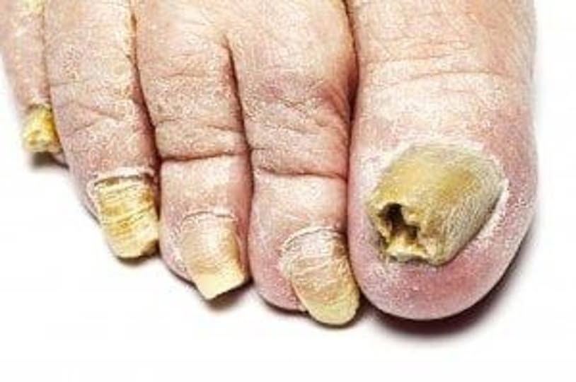 Simple and safe ways to cure ugly toenails