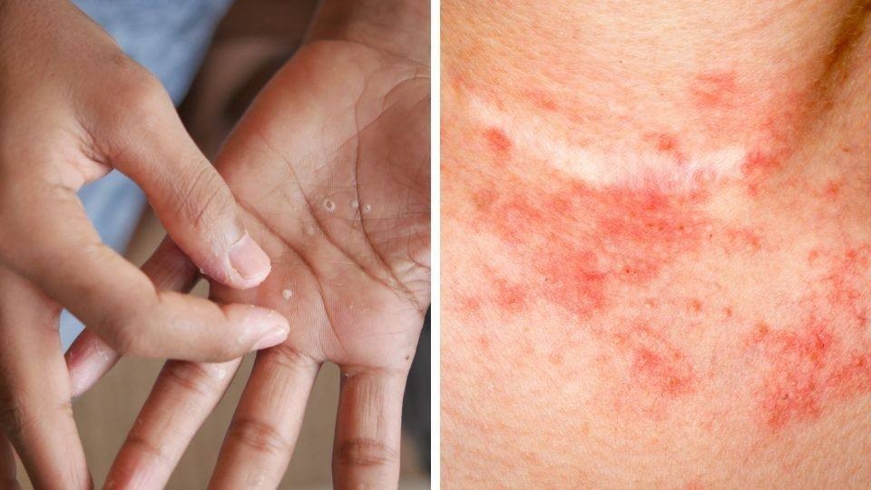 If You Notice Painful Red Bumps, You Might Have Dyshidrotic Eczema