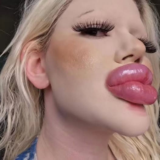 24-year-old Bulgarian woman wants to have the biggest lips in the world