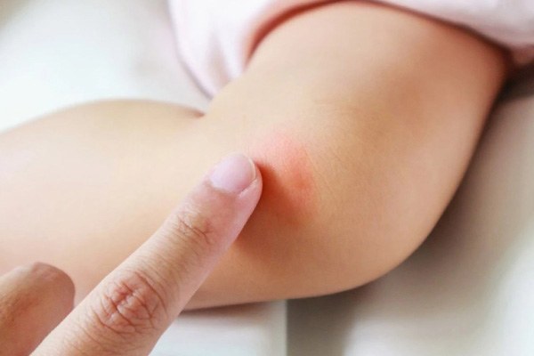 Mosquito Bites: Quick and Easy Relief with a Time-Tested Solution