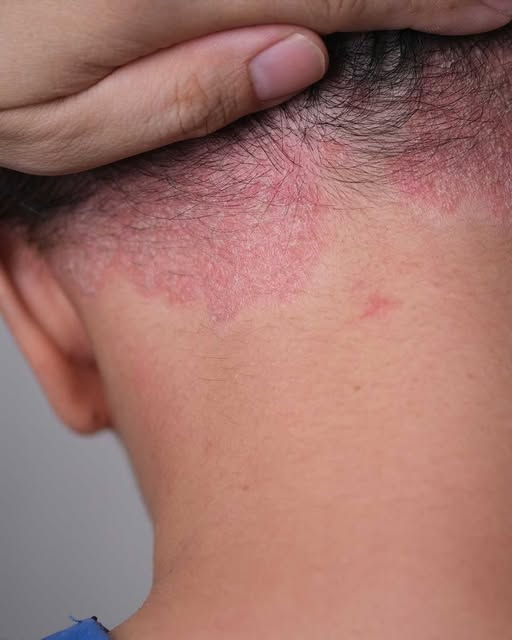 Discovered this red patch on my grandson and everyone is freaking out. What is it and what should we do?