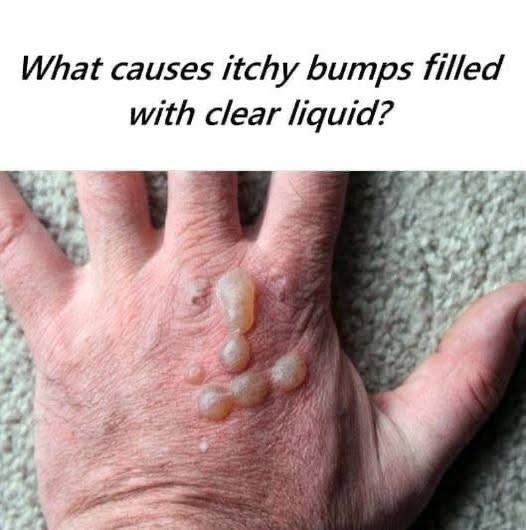 What causes itchy bumps filled with clear liquid?