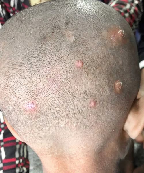 What to Do When Scalp Bumps Appear on Your Child: A Guide for Concerned Parents