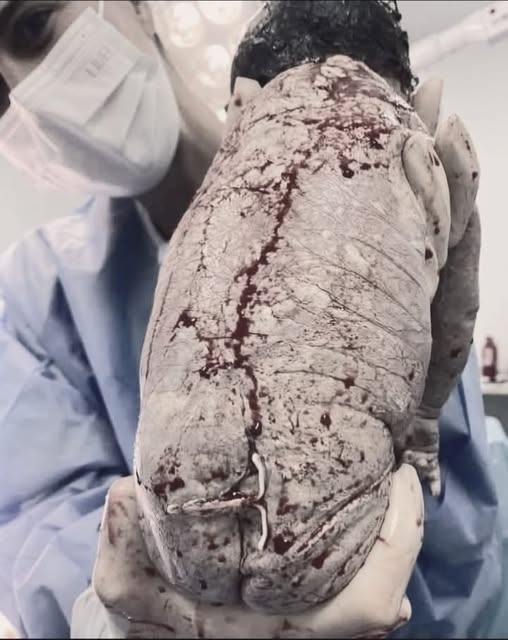 Baby born with an DIU peg…