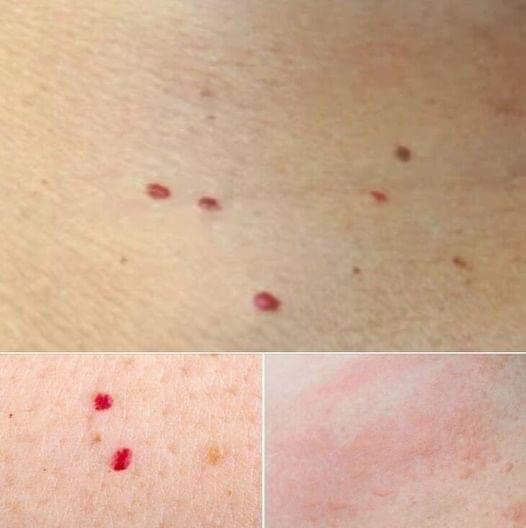 What Those Mysterious Red Dots on Your Skin Could Mean