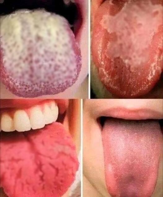8 Things That Your Tongue Tell You About Your Health