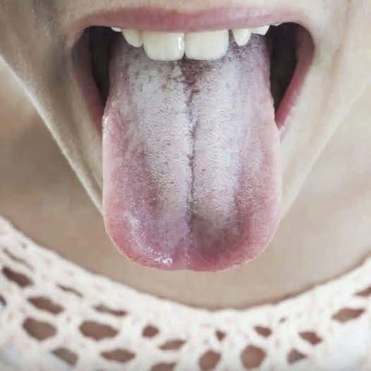 If your tongue is white, this is a clear sign that you are suffering from…