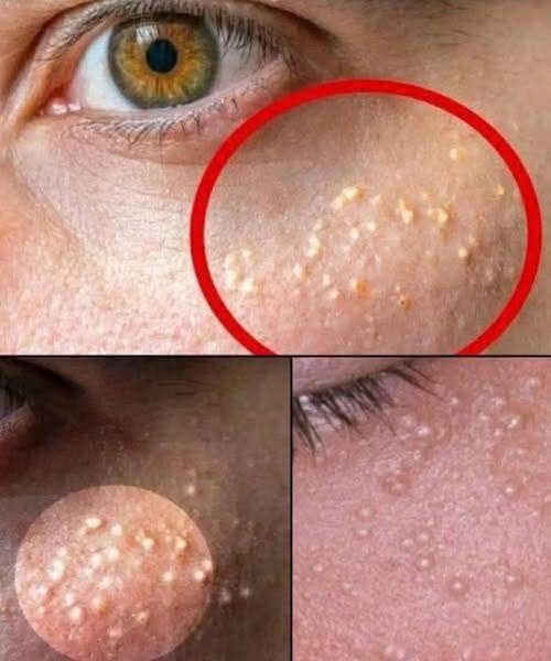 When White Bumps Appear on Your Skin, What Is Your Body Trying to Tell You?