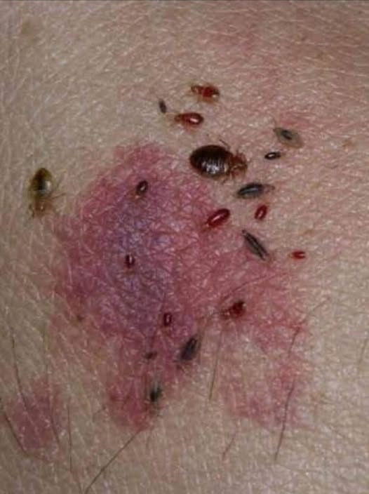 BE CAREFUL if you get these bruises on your body, it means you have Ca…