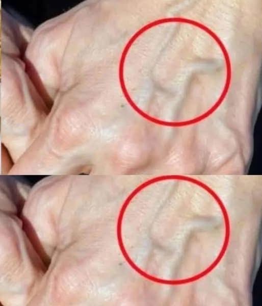When should you be concerned about suddenly appearing veins?