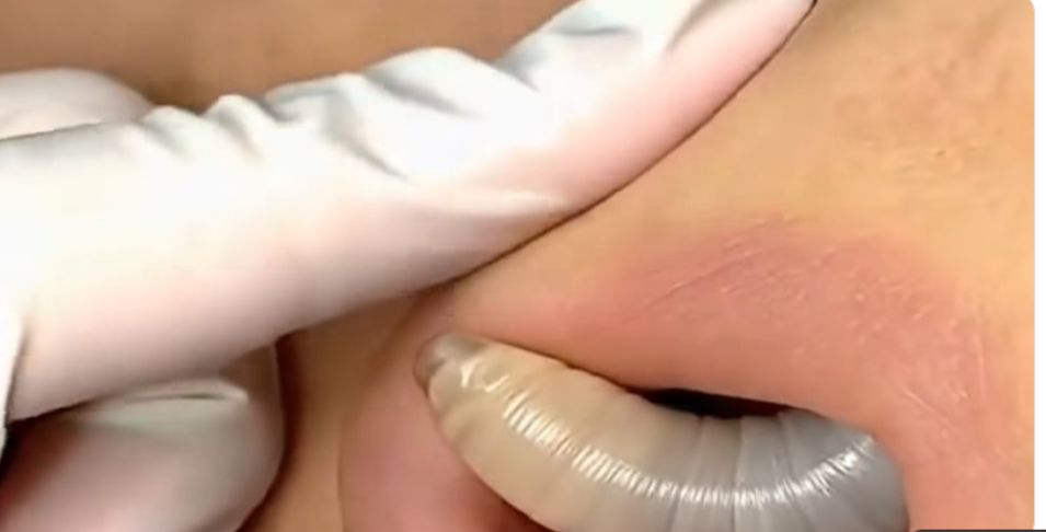 Larvae found in a young woman…