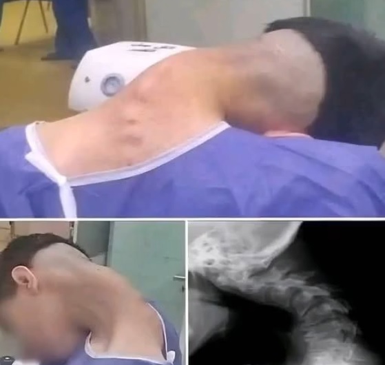 A Life-Altering Incident: Heavy Object Falling on Head Caused Fatal Cervical Spine Fracture in 18-Year-Old Worker