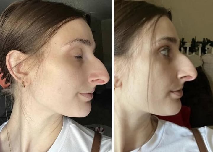 People Can’t Believe How This Woman Looks After Getting A $11k Nose Job
