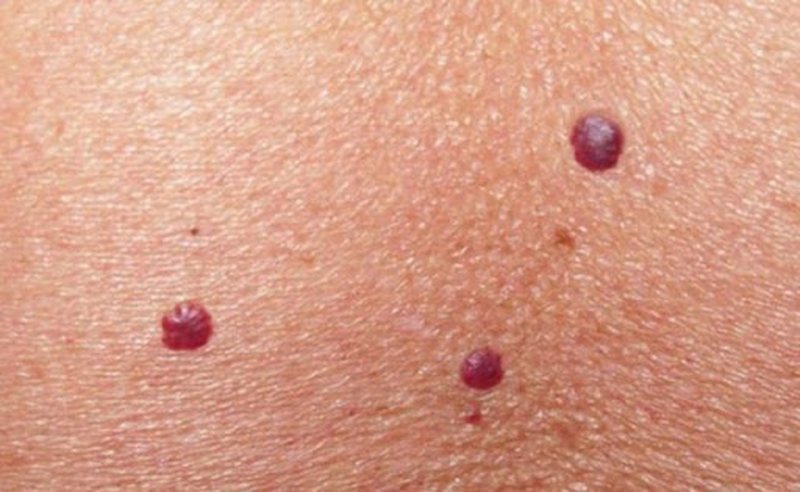 Çfarë i shkakton nishanet e kuq në trup dhe a trajtohen ato?