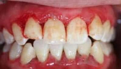 Bleeding gums during tooth brushing could indicate your blood is lacking crucial… See more