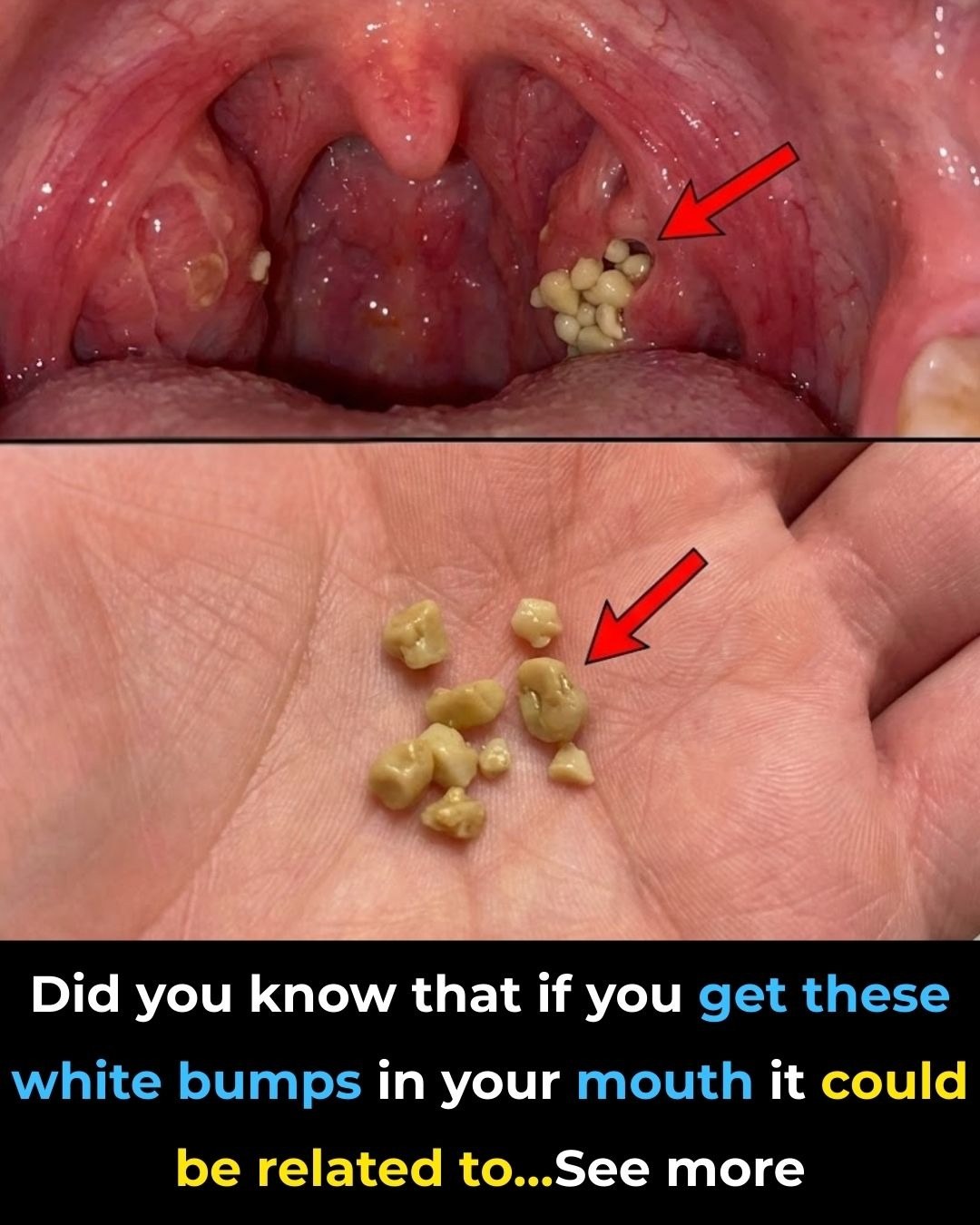 Tonsil Stones: Understanding the Small Lumps That Cause Big Annoyance