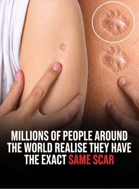 Why Do So Many People Have the Same Small Scar? The Mystery Behind a Global Mark