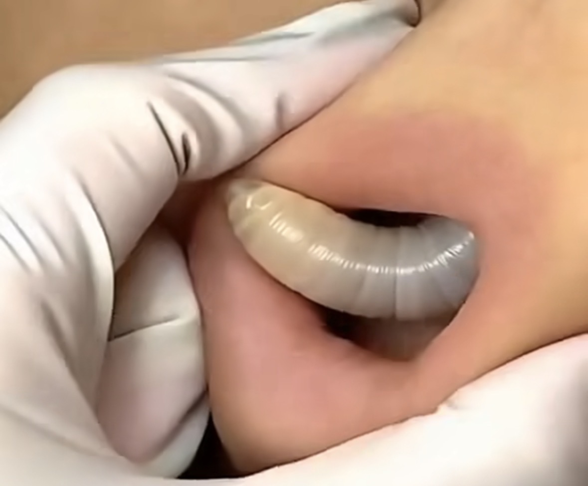 Larvae found in a young woman…