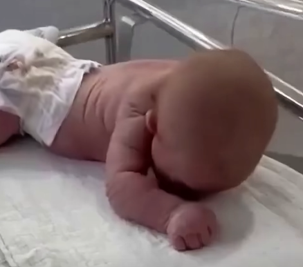 Baby born with an DIU peg…